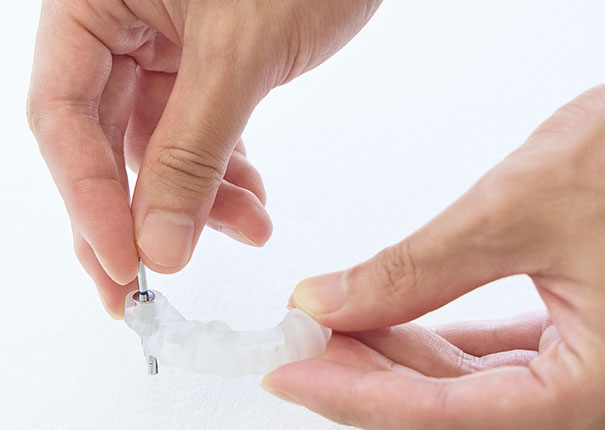 抜歯即時インプラントで期間短縮