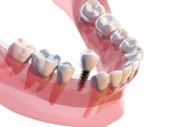 抜歯即時インプラントとは