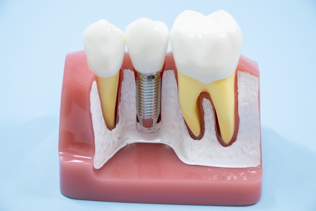 歯周病とインプラントの関係
